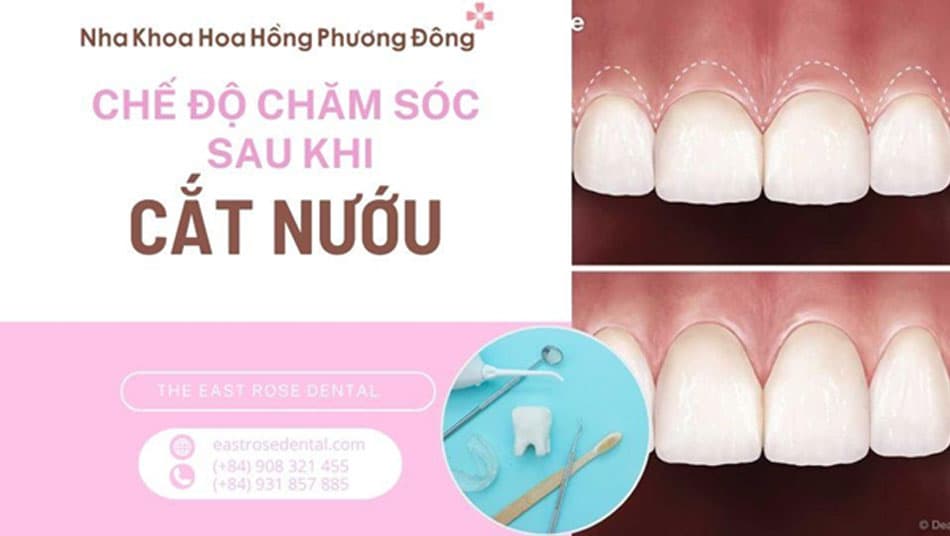 Chế độ chăm sóc sau phẫu thuật thẩm mỹ nướu