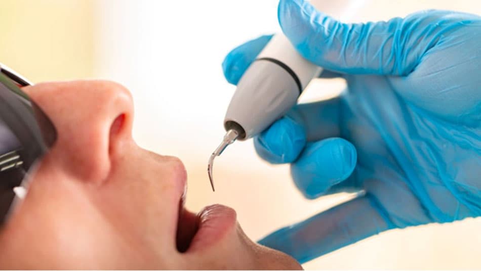 Teeth scaling helps reduce plaque buildup, preventing cavities and gum inflammation