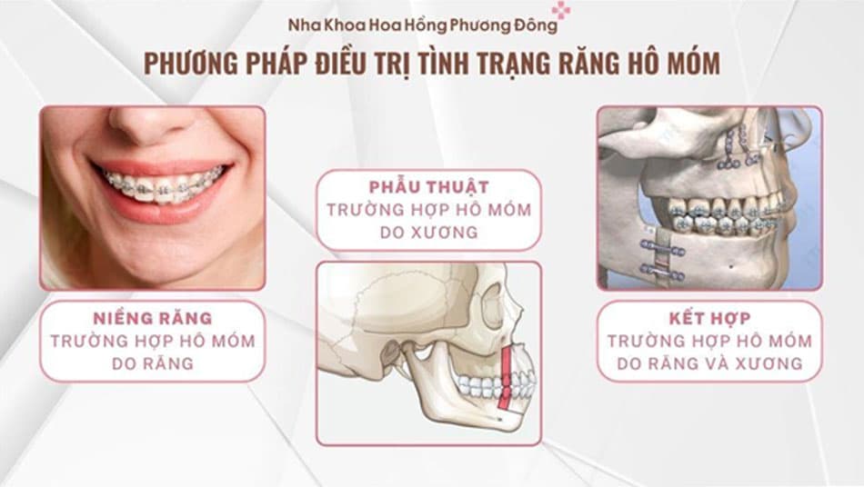 Phương pháp điều trị tình trạng hô móm
