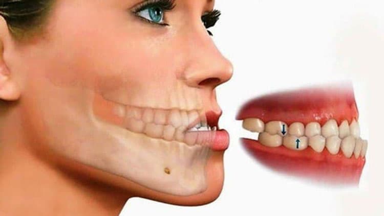 Protruding and underbite teeth due to bone and dental structure is complex