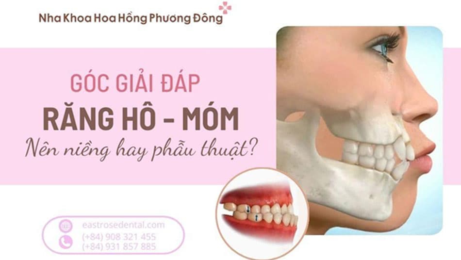 Góc giải đáp: Răng hô và móm nên niềng răng hay phẫu thuật?