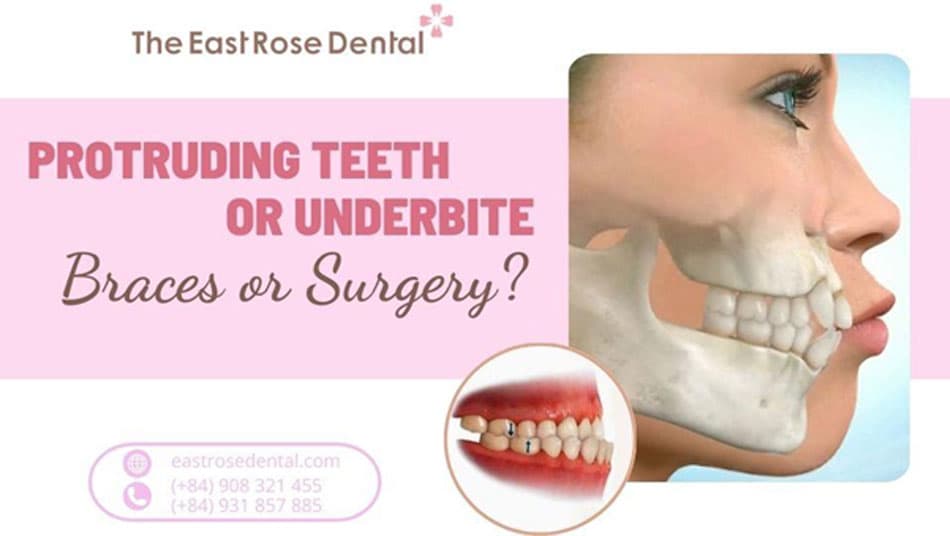 Should protruding or underbite teeth get braces or surgery?