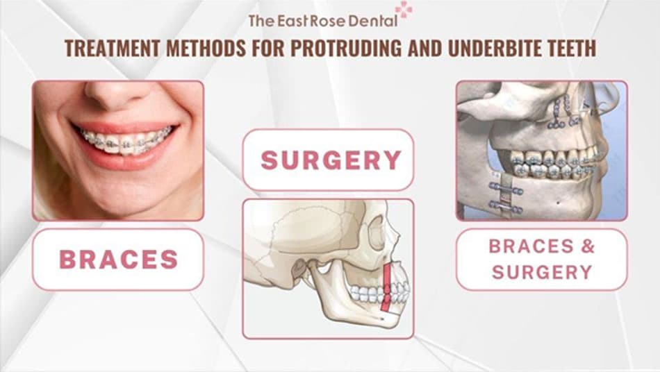 Treatment methods for protruding and underbite teeth