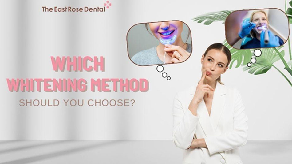 Choosing the right whitening method based on budget and dental health