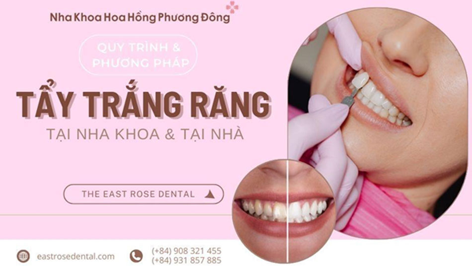  Quy trình và phương pháp tẩy trắng răng tại phòng nha và tại nhà 