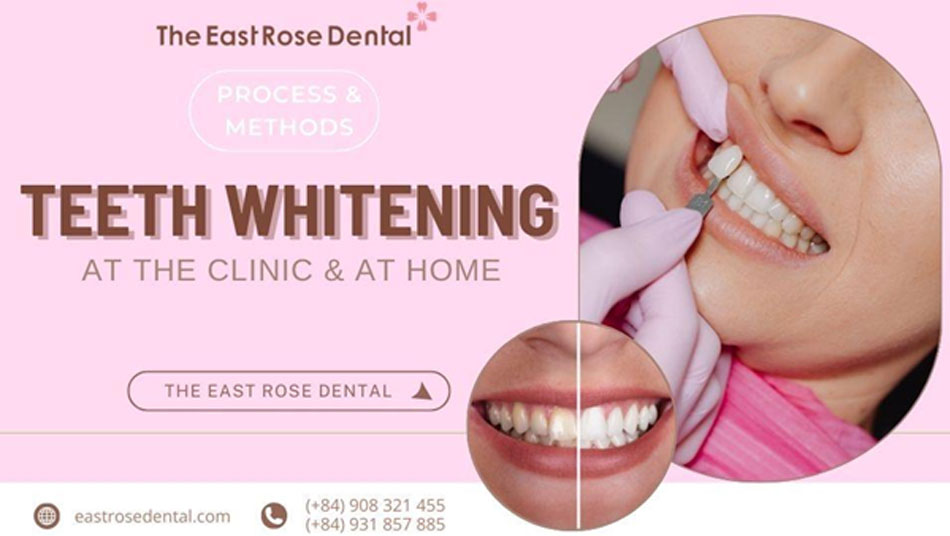 Teeth whitening procedures at the dental office and at home