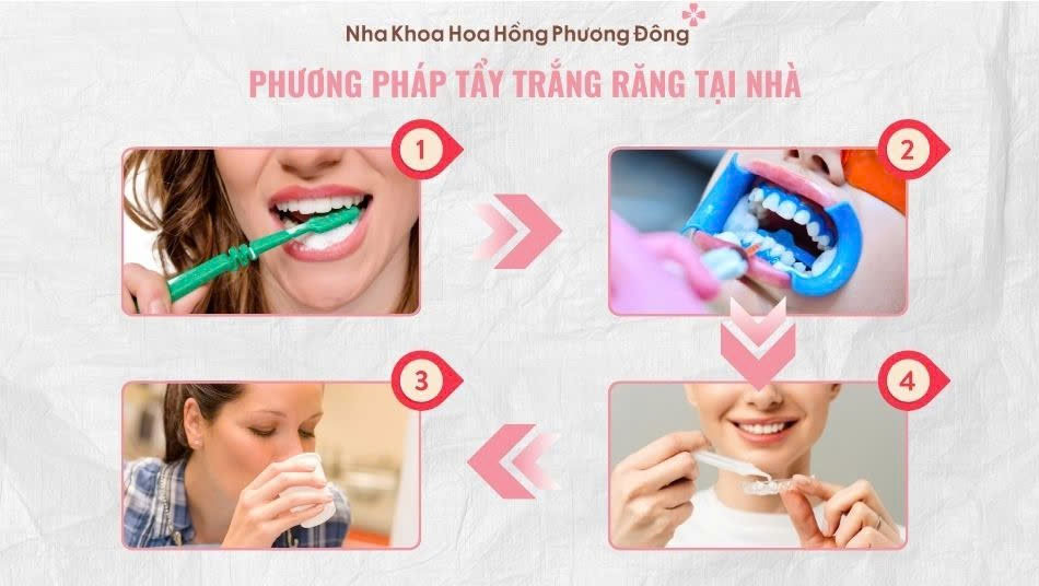 Quy trình thực hiện tẩy trắng răng tại nhà