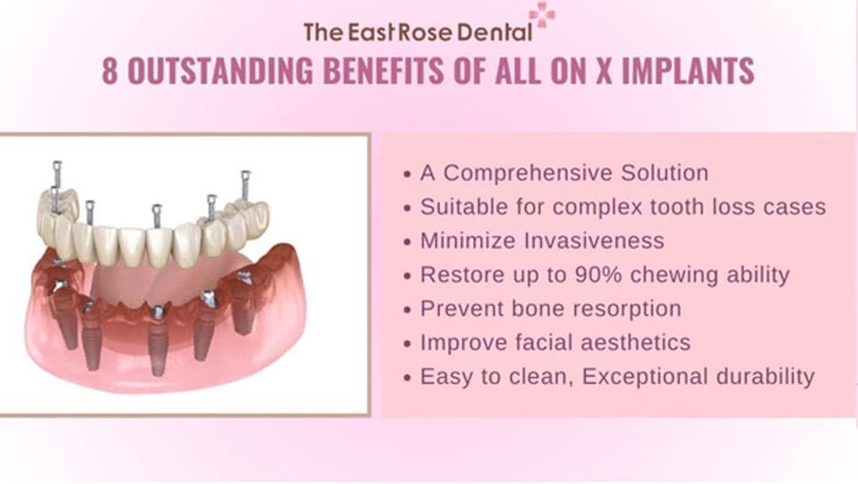 All On X Implants Offer Exceptional Benefits