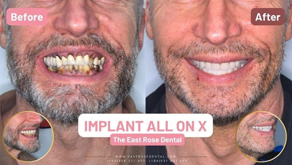 All On X restoration enhances aesthetics exceptionally