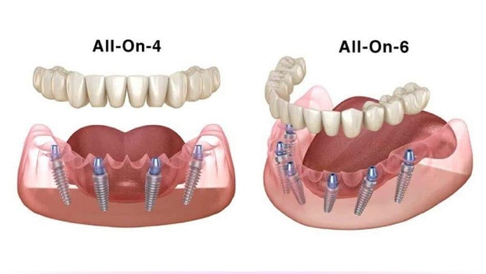 Cải thiện khả năng ăn nhai ngay sau khi cấy ghép All On X