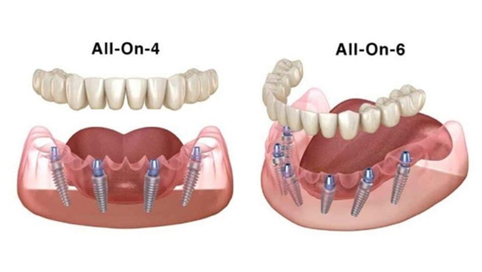 Improves chewing ability immediately after All On X Implant placement