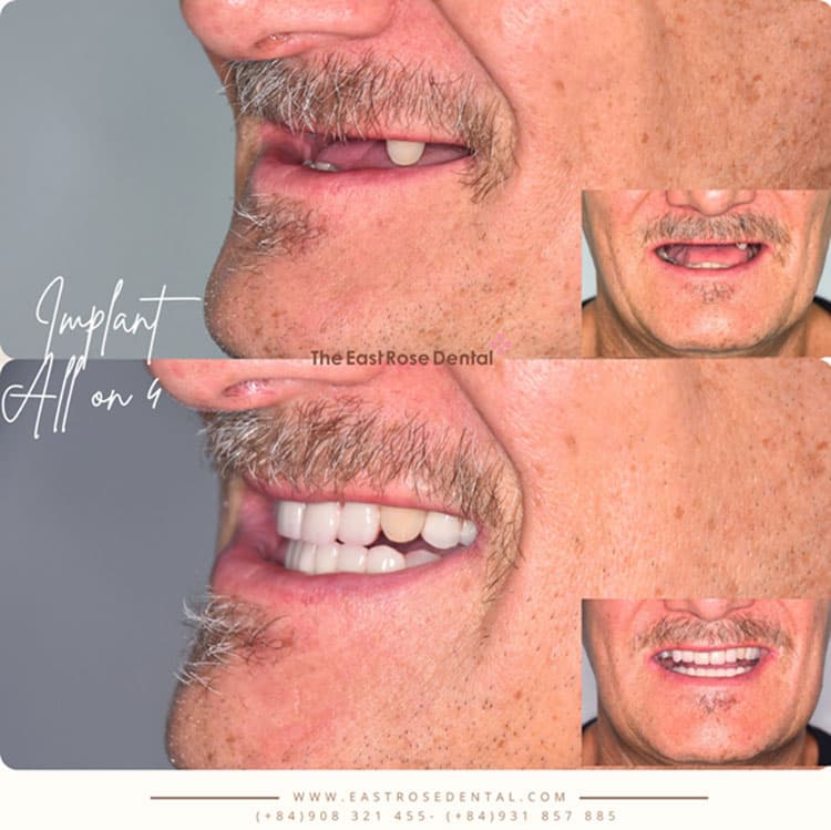 Results of All On 4 Implantation at The East Rose Dental Clinic