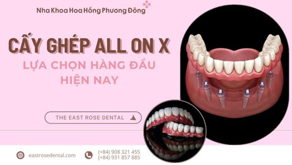Tại sao cấy ghép All On X là lựa chọn hàng đầu hiện nay?