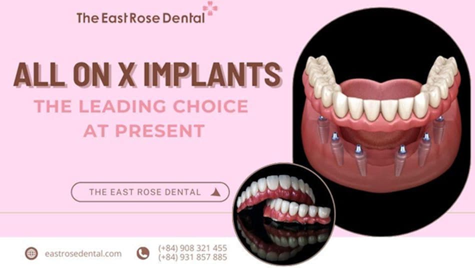 Why is the All On X implant the top choice at present?