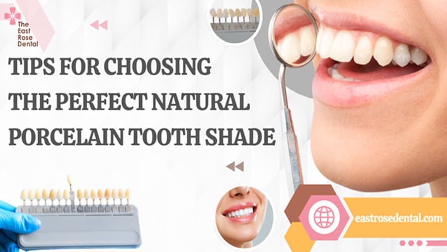 Experience in Choosing the Right Dental Crown Shade for a Natural Smile