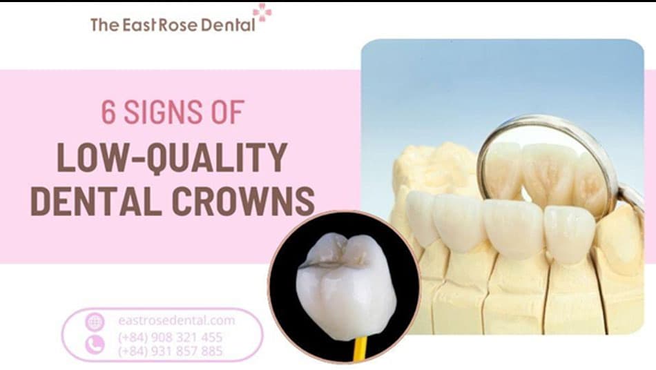 6 Signs to Recognise Genuine and Low-Quality Dental Crowns