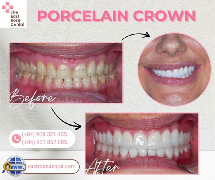 Customers Who Get Aesthetic Dental Crowns at The East Rose Dental Clinic