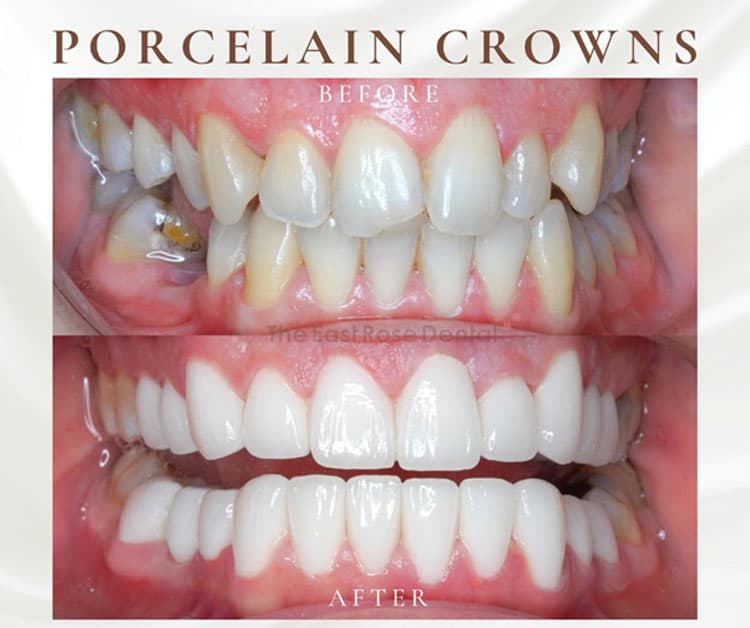 Results of Dental Crowning at The East Rose Dental Clinic