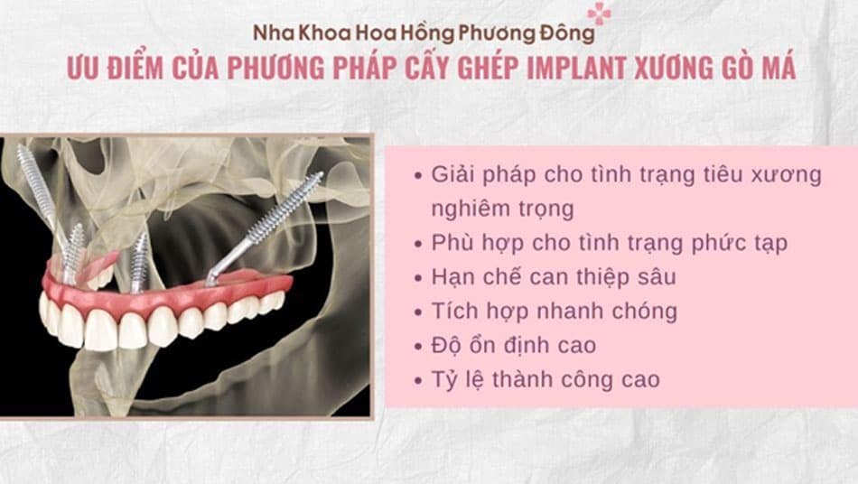 Ưu điểm của phương pháp cấy ghép Implant xương gò má
