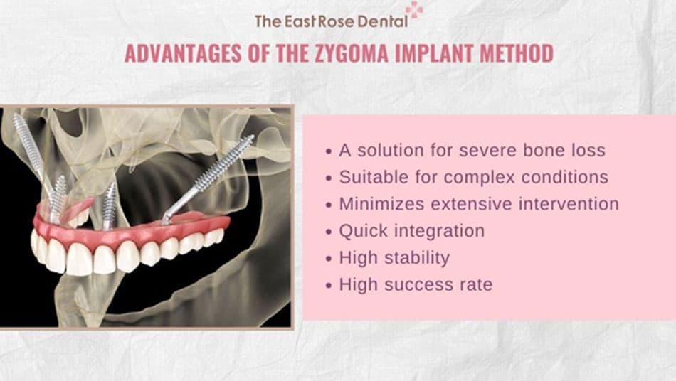 Advantages of Zygoma Implant method
