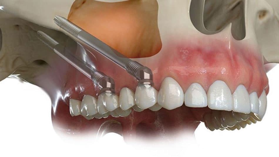 Cases requiring Zygoma Implant intervention