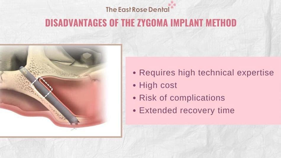 Disadvantages of Zygoma Implant Method