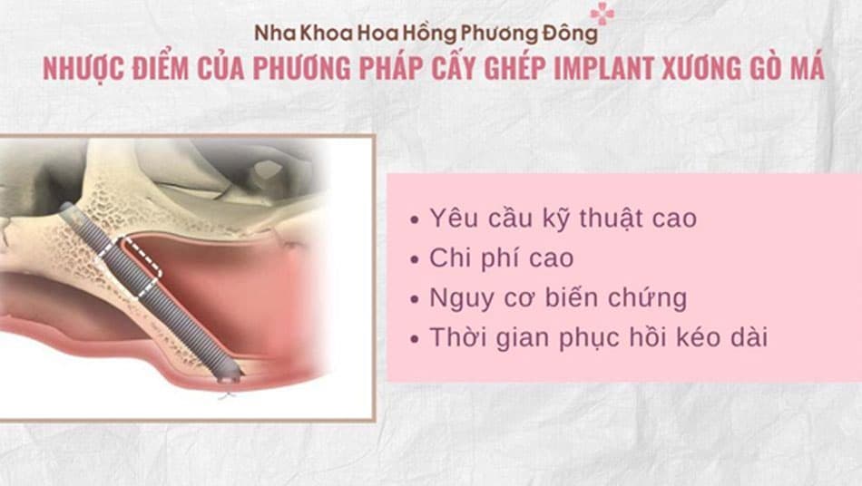 Nhược điểm của phương pháp cấy ghép Implant xương gò má: