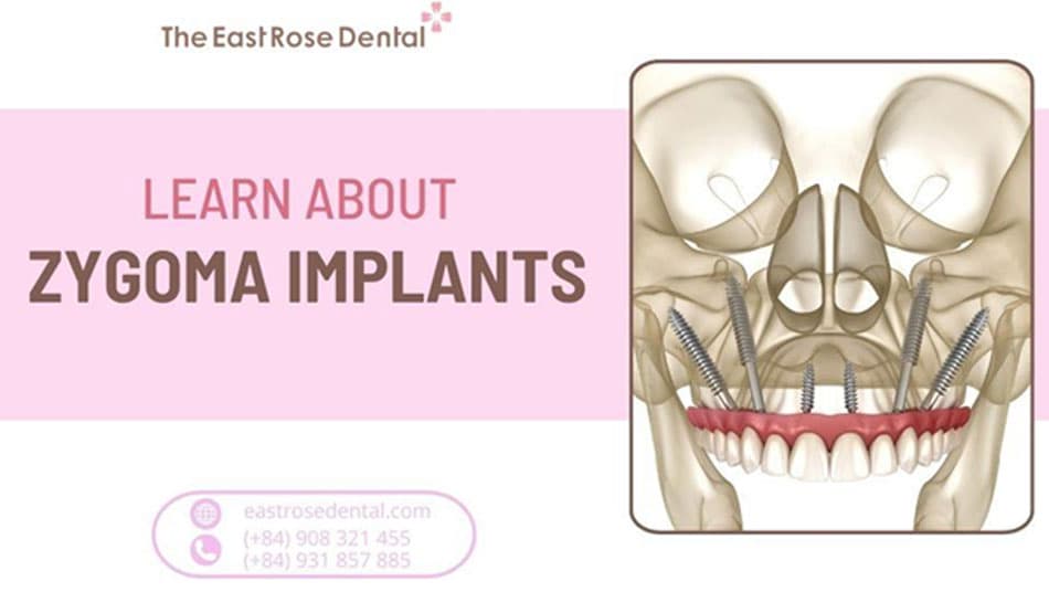 What are Zygoma Implants? When should they be performed?