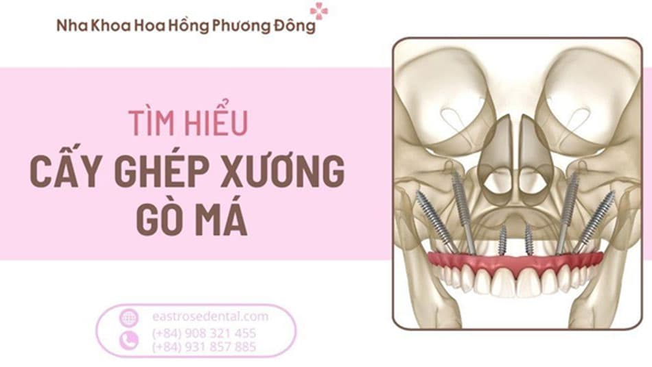 Cấy ghép xương gò má là gì? Khi nào cần thực hiện cấy ghép
