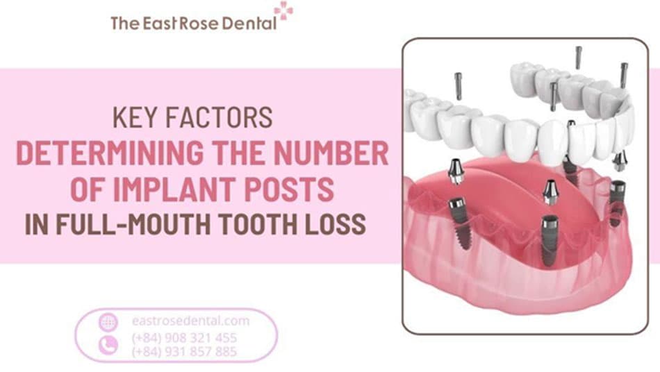 Factors Determining Implant Posts for Full-Mouth Tooth Loss