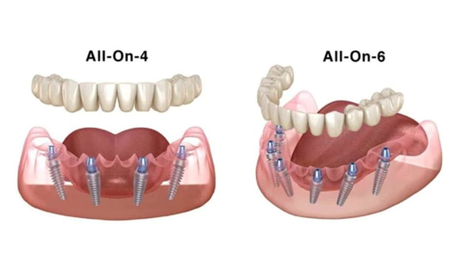 Kỹ thuật cấy ghép All On 4 và All On 6 yêu cầu số lượng trụ khác nhau