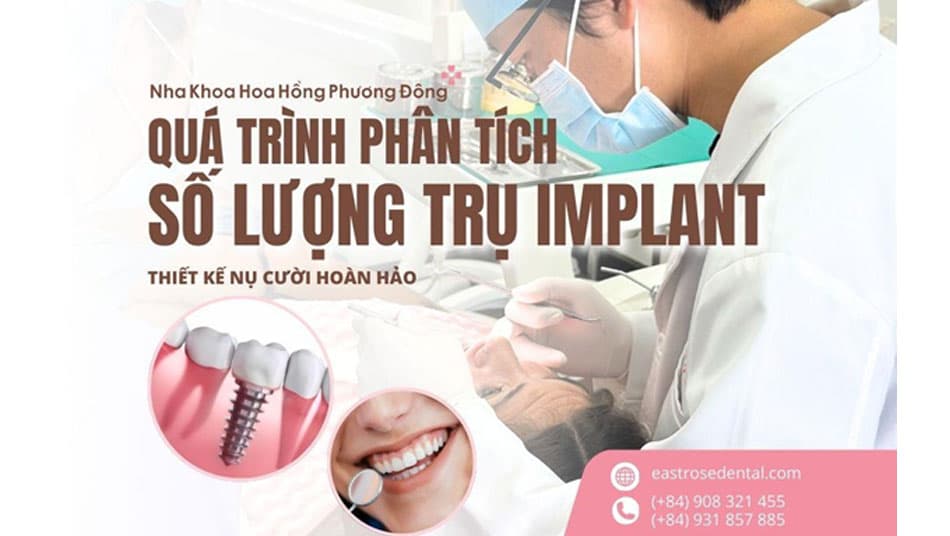 Quy trình phân tích số lượng cấy trụ Implant cần cấy ghép