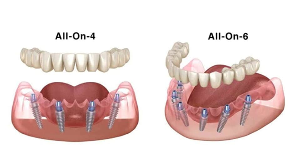 The All-on-4 and All-on-6 implant techniques require different numbers of posts