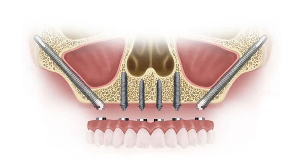 The condition of the jawbone plays a crucial role