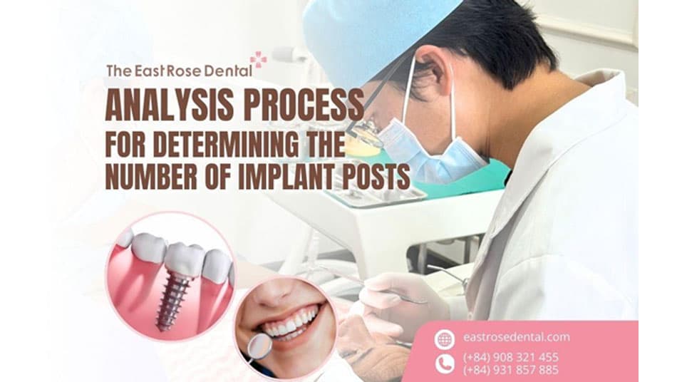 The process of analyzing the number of implant posts needed for placement