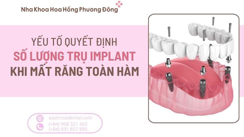 Yếu Tố Quyết Định Số Lượng Trụ Implant Khi Mất Răng Toàn Hàm