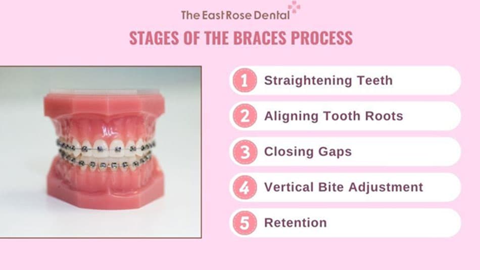 Braces require time and patience
