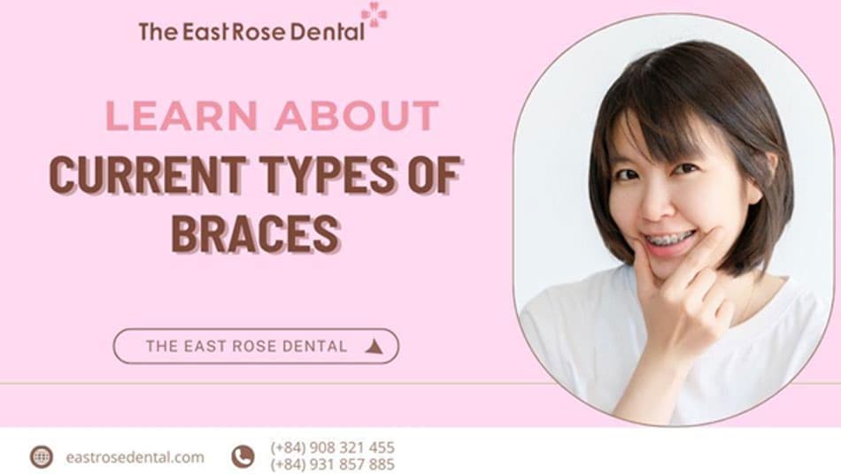 How many types of braces are there? Do they weaken the teeth?
