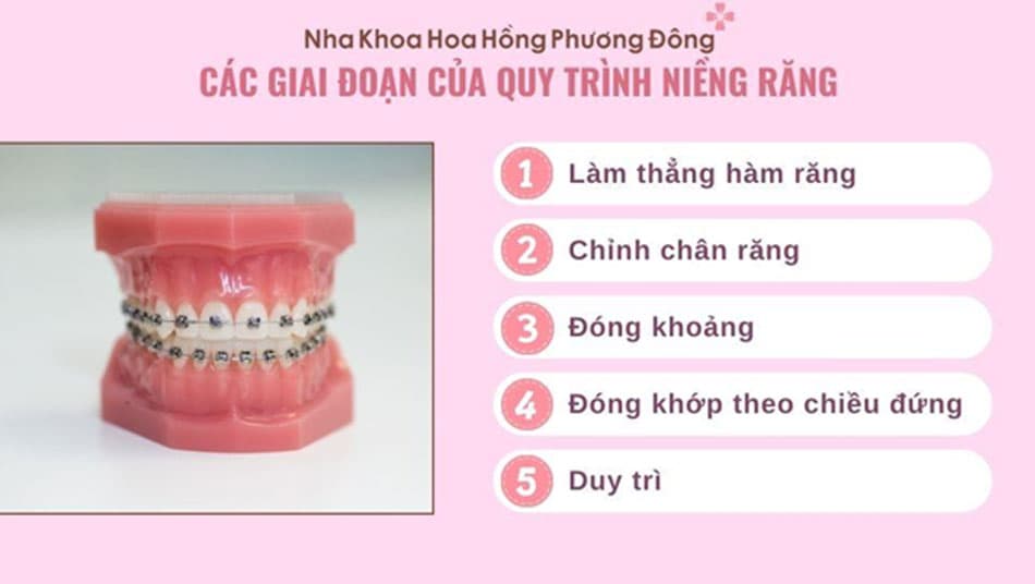 Niềng răng đòi hỏi thời gian và sự kiên trì