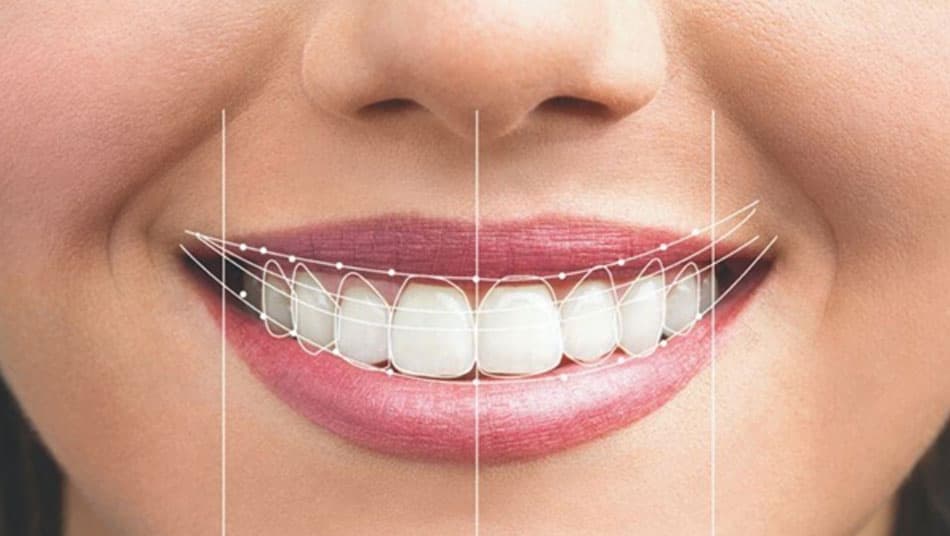 The gum line is an important factor that helps make the smile more elegant