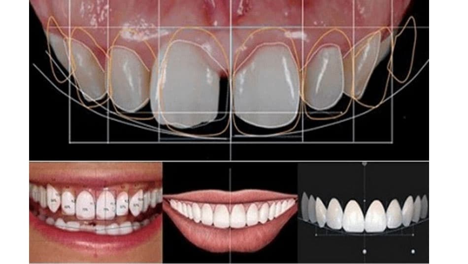 The perfect ratio between teeth and gums when smiling