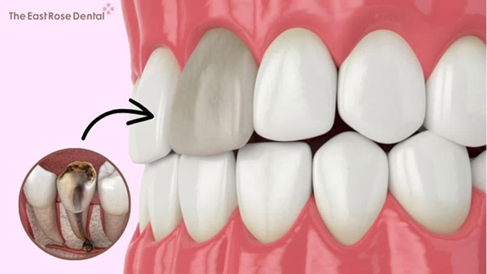 A devitalized tooth causes discoloration, leading to aesthetic concerns