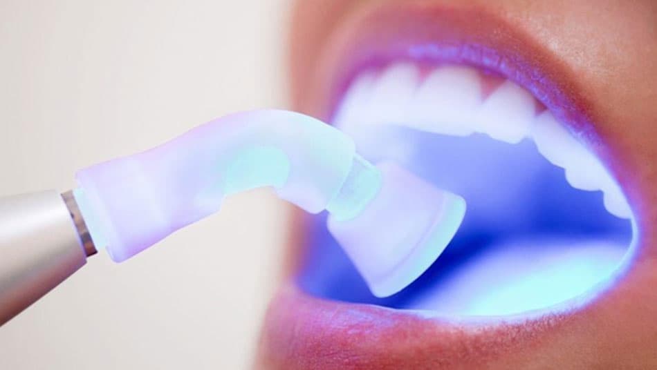 Cosmetic fillings require careful maintenance over time
