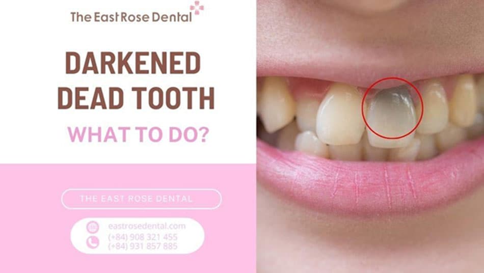 Darkened Devitalized Tooth: How Can It Be Improved?