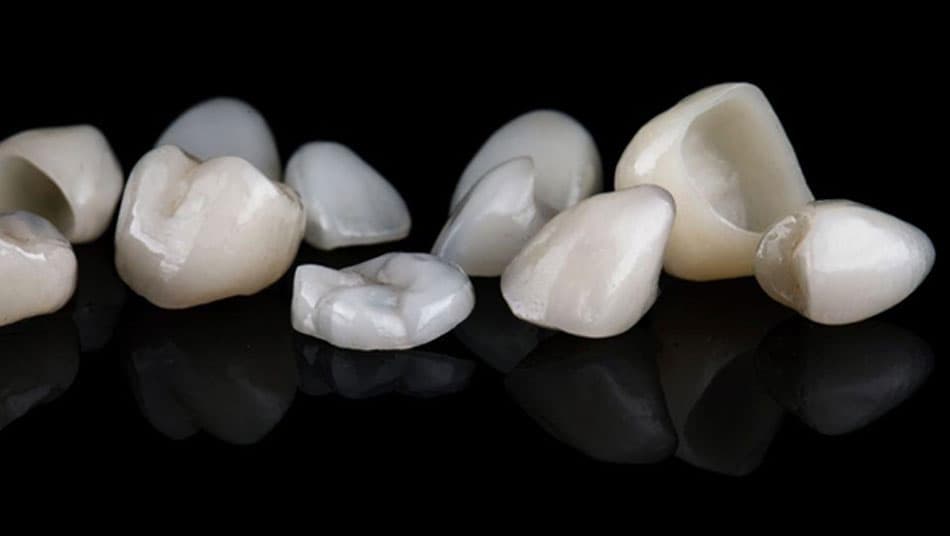 Dental crowns are the optimal solution when teeth discolor due to devitalization