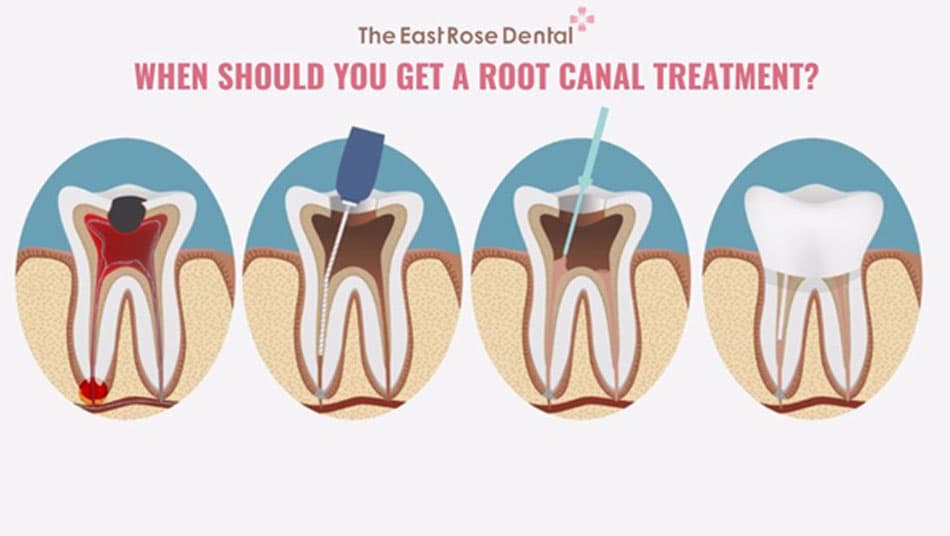 It is best to treat the pulp as early as possible to minimize treatment costs