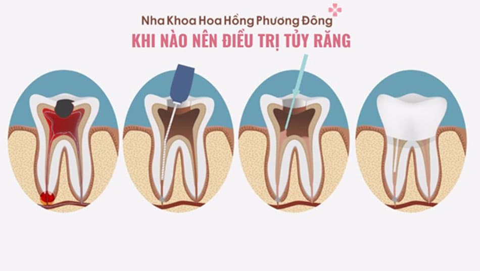 Nên điều trị tủy càng sớm càng tốt để hạn chế chi phí điều trị