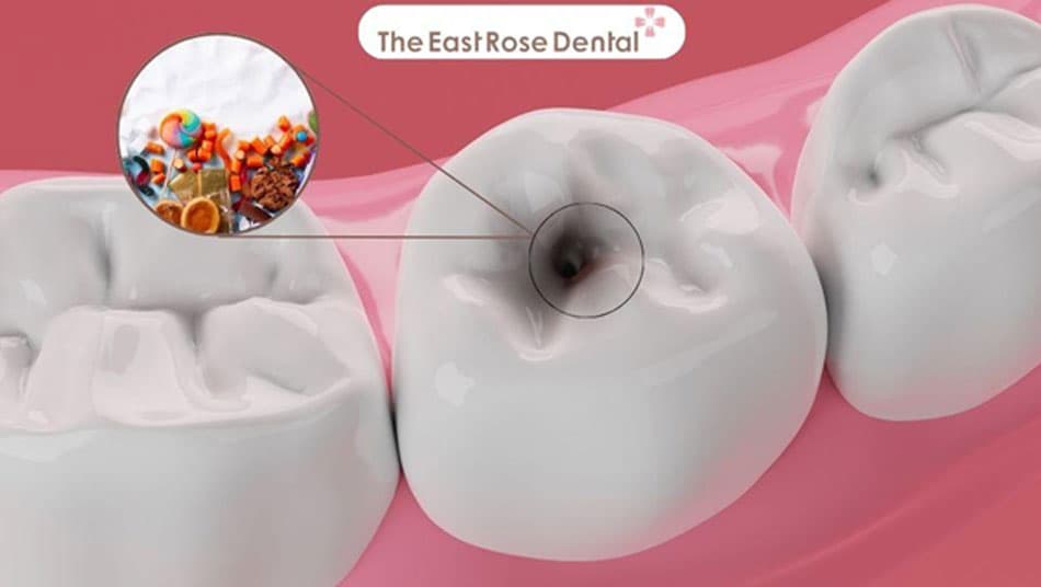 Đường là một trong những nguyên nhân chính gây sâu răng