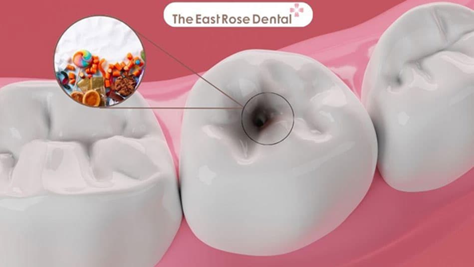 Sugar is a primary cause of cavities