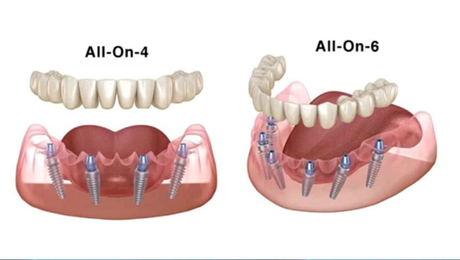 Kỹ thuật dời thần kinh áp dụng cho trường hợp cấy ghép số lượng Implant lớn